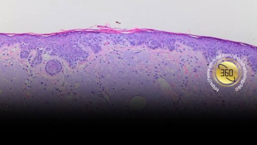 Histopathology slide of actinic cheilitis showing epithelial dysplasia with irregular epithelial stratification and chronic sun-induced changes, as discussed in Oral Pathology 360 lecture.