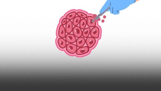 Illustration of scalpel removing biopsy from a cluster of cells, representing biopsy technique for suspected malignant oral lesions.
