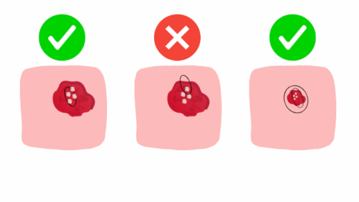 Illustration of oral biopsy techniques showing correct incisional biopsy within the lesion, incorrect biopsy extending into normal tissue, and excisional biopsy for small lesions with 3–4 mm margin.