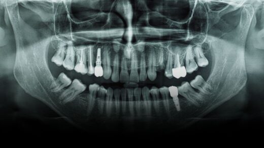 Panoramic radiograph showing mandibular third molars and dental implants near the inferior alveolar canal.