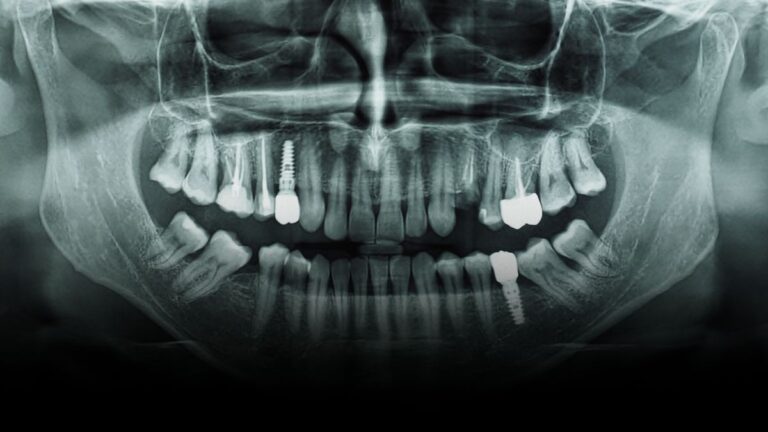 Panoramic radiograph showing mandibular third molars and dental implants near the inferior alveolar canal.